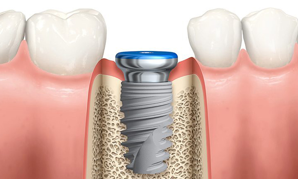 تأثیر سابقه و توانایی دندانپزشک متخصص ایمپلنت بر قیمت‌ها