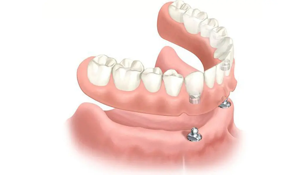 هزینه ایمپلنت‌گذاری چند واحدی در تهران چرا هزینه ایمپلنت‌گذاری چند واحدی در تهران متفاوت است؟ تهران شهری است با تنوع زیاد در نوع خدمات دندانپزشکی. همین تنوع باعث می‌شود قیمت‌ها از یک مرکز تا مرکز دیگر تفاوت داشته باشد. عوامل زیر بیشترین تأثیر را بر رقم نهایی دارند: ۱. برند ایمپلنت (مهم‌ترین عامل) ایمپلنت‌ها از نظر کیفیت ساخت، کشور سازنده، میزان ماندگاری و تکنولوژی‌های مورد استفاده با هم تفاوت دارند. کشورهای مطرح در تولید ایمپلنت عبارتند از: • سوئیس • آلمان • کره • آمریکا • ایتالیا • اسپانیا • چین (کیفیت پایین‌تر اما اقتصادی) هرچه برند معتبرتر باشد، قیمت قطعات و هزینه ایمپلنت‌گذاری نیز بالاتر خواهد بود. ایمپلنت‌های اروپایی و آمریکایی معمولاً بیشترین طول عمر و کمترین درصد شکست را دارند. ایمپلنت‌های کره‌ای کیفیت مناسب و قیمت منطقی‌تری دارند، به همین دلیل محبوب هستند. ۲. تعداد واحدهای مورد نیاز به‌طور طبیعی، هرچه تعداد دندان‌های ازدست‌رفته بیشتر باشد، هزینه درمان نیز افزایش پیدا می‌کند. اما نکته مهم این است که برای چند دندان کنار هم معمولاً نیاز به تعداد پایه کمتری دارید و این مسئله هزینه را منطقی‌تر می‌کند. ۳. جنس و نوع روکش روکش‌های دندانی انواع مختلفی دارند: • سرامیکی • زیرکونیا • سرامیک-فلز روکش‌های زیرکونیا از نظر زیبایی و مقاومت بهترین گزینه هستند اما قیمت بالاتری دارند. ۴. نیاز به جراحی‌های تکمیلی بعضی بیماران برای شروع ایمپلنت‌گذاری نیاز به اقدامات اضافه دارند، مثل: • پیوند استخوان • لیفت سینوس • کشیدن دندان‌های خراب • جراحی لثه • تقویت بافت نرم وجود یا عدم وجود این مراحل مستقیماً روی هزینه ایمپلنت‌گذاری تأثیر می‌گذارد. ۵. مهارت و تجربه دندانپزشک ایمپلنت‌گذاری چند واحدی یک فرایند دقیق، مهم و حساس است. هرچه متخصص تجربه بیشتری داشته باشد، احتمال موفقیت و عمر ایمپلنت‌ها بیشتر خواهد بود. طبیعی است که هزینه خدمات متخصصان باتجربه کمی بیشتر باشد، اما نتیجه درمان قابل‌اعتمادتر است. هزینه ایمپلنت‌گذاری چند واحدی در تهران چقدر است؟ در تهران، هزینه ایمپلنت‌گذاری چند واحدی حدودی و متغیر است. دلیل این تفاوت همان عواملی است که در بخش قبل توضیح داده شد. با این حال، برای آگاهی کلی، بازه‌های تقریبی هزینه‌ها به شکل زیر است: هزینه تقریبی پایه ایمپلنت (برای هر واحد): • برندهای اقتصادی: از ۱۵ میلیون تومان به بالا • برندهای کره‌ای باکیفیت: بین ۱۸ تا ۳۰ میلیون تومان • برندهای اروپایی: بین ۳۰ تا ۵۵ میلیون تومان • برندهای آمریکایی و سوئیسی: از ۵۵ میلیون تومان به بالا هزینه روکش دندان (برای هر واحد): • سرامیک: ۳ تا ۵ میلیون • زیرکونیا: ۵ تا ۸ میلیون • سرامیک-فلز: ۲ تا ۴ میلیون هزینه جراحی‌های تکمیلی (در صورت نیاز): • پیوند استخوان: ۵ تا ۱۵ میلیون • لیفت سینوس: ۱۰ تا ۳۰ میلیون این قیمت‌ها حدودی هستند و بسته به شرایط دهان، فک و روش انتخابی شما کاهش یا افزایش پیدا می‌کنند. مزایای ایمپلنت‌گذاری چند واحدی نسبت به روش‌های دیگر وقتی چند دندان از دست رفته باشد، روش‌های مختلفی برای جایگزینی وجود دارد، اما ایمپلنت‌گذاری مزایای بسیار مهمی دارد که باعث شده تبدیل به بهترین گزینه شود: ۱. جلوگیری از تحلیل استخوان وقتی دندان طبیعی از بین می‌رود، استخوان فک شروع به تحلیل می‌کند، اما ایمپلنت باعث تحریک استخوان می‌شود و جلوی این روند را می‌گیرد. ۲. عدم آسیب به دندان‌های کناری برخلاف بریج، برای ایمپلنت نیازی نیست دندان‌های سالم کناری تراش داده شوند. ۳. دوام و ماندگاری طولانی ایمپلنت‌های باکیفیت در صورت مراقبت درست، تا آخر عمر باقی می‌مانند. ۴. زیبایی لبخند و بازگشت اعتمادبه‌نفس روکش‌های امروزی ظاهر طبیعی و هماهنگ با سایر دندان‌ها دارند و لبخند را کاملاً زیبا می‌کنند. ۵. عملکرد طبیعی در غذا خوردن ایمپلنت مانند دندان واقعی عمل می‌کند و هیچ محدودیتی در جویدن ایجاد نمی‌کند. هزینه ایمپلنت‌گذاری چند واحدی چگونه کاهش می‌یابد؟ در بسیاری از موارد، می‌توان با انتخاب روش‌ها و برندهای مناسب، هزینه‌ها را مدیریت کرد بدون اینکه کیفیت درمان کاهش پیدا کند. ۱. انتخاب برند باکیفیت اما اقتصادی برندهای کره‌ای درجه یک بهترین تعادل میان کیفیت و هزینه را دارند. ۲. استفاده از روکش‌های استاندارد روکش‌های سرامیکی کیفیت خوبی دارند و نسبت به زیرکونیا ارزان‌ترند. ۳. درمان در زمان مناسب هرچه تحلیل استخوان کمتر باشد، نیاز به جراحی‌های تکمیلی کمتر خواهد شد. ۴. رعایت مراقبت‌های بعد از جراحی برای جلوگیری از مشکلات بعدی، رعایت بهداشت دهان بسیار مهم است.