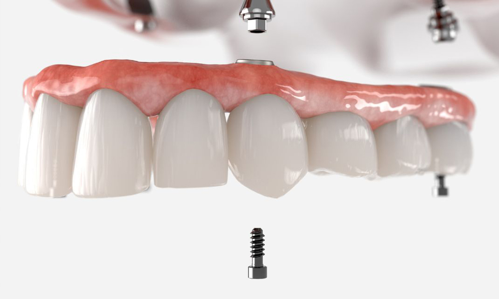 هزینه ایمپلنت‌گذاری چند واحدی در تهران