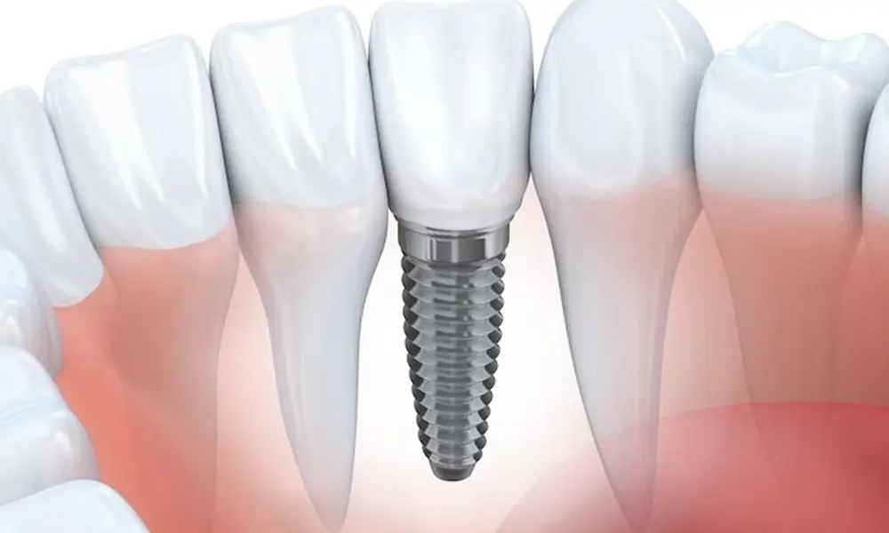 هزینه ایمپلنت‌گذاری چند واحدی در تهران چرا هزینه ایمپلنت‌گذاری چند واحدی در تهران متفاوت است؟ تهران شهری است با تنوع زیاد در نوع خدمات دندانپزشکی. همین تنوع باعث می‌شود قیمت‌ها از یک مرکز تا مرکز دیگر تفاوت داشته باشد. عوامل زیر بیشترین تأثیر را بر رقم نهایی دارند: ۱. برند ایمپلنت (مهم‌ترین عامل) ایمپلنت‌ها از نظر کیفیت ساخت، کشور سازنده، میزان ماندگاری و تکنولوژی‌های مورد استفاده با هم تفاوت دارند. کشورهای مطرح در تولید ایمپلنت عبارتند از: • سوئیس • آلمان • کره • آمریکا • ایتالیا • اسپانیا • چین (کیفیت پایین‌تر اما اقتصادی) هرچه برند معتبرتر باشد، قیمت قطعات و هزینه ایمپلنت‌گذاری نیز بالاتر خواهد بود. ایمپلنت‌های اروپایی و آمریکایی معمولاً بیشترین طول عمر و کمترین درصد شکست را دارند. ایمپلنت‌های کره‌ای کیفیت مناسب و قیمت منطقی‌تری دارند، به همین دلیل محبوب هستند. ۲. تعداد واحدهای مورد نیاز به‌طور طبیعی، هرچه تعداد دندان‌های ازدست‌رفته بیشتر باشد، هزینه درمان نیز افزایش پیدا می‌کند. اما نکته مهم این است که برای چند دندان کنار هم معمولاً نیاز به تعداد پایه کمتری دارید و این مسئله هزینه را منطقی‌تر می‌کند. ۳. جنس و نوع روکش روکش‌های دندانی انواع مختلفی دارند: • سرامیکی • زیرکونیا • سرامیک-فلز روکش‌های زیرکونیا از نظر زیبایی و مقاومت بهترین گزینه هستند اما قیمت بالاتری دارند. ۴. نیاز به جراحی‌های تکمیلی بعضی بیماران برای شروع ایمپلنت‌گذاری نیاز به اقدامات اضافه دارند، مثل: • پیوند استخوان • لیفت سینوس • کشیدن دندان‌های خراب • جراحی لثه • تقویت بافت نرم وجود یا عدم وجود این مراحل مستقیماً روی هزینه ایمپلنت‌گذاری تأثیر می‌گذارد. ۵. مهارت و تجربه دندانپزشک ایمپلنت‌گذاری چند واحدی یک فرایند دقیق، مهم و حساس است. هرچه متخصص تجربه بیشتری داشته باشد، احتمال موفقیت و عمر ایمپلنت‌ها بیشتر خواهد بود. طبیعی است که هزینه خدمات متخصصان باتجربه کمی بیشتر باشد، اما نتیجه درمان قابل‌اعتمادتر است. هزینه ایمپلنت‌گذاری چند واحدی در تهران چقدر است؟ در تهران، هزینه ایمپلنت‌گذاری چند واحدی حدودی و متغیر است. دلیل این تفاوت همان عواملی است که در بخش قبل توضیح داده شد. با این حال، برای آگاهی کلی، بازه‌های تقریبی هزینه‌ها به شکل زیر است: هزینه تقریبی پایه ایمپلنت (برای هر واحد): • برندهای اقتصادی: از ۱۵ میلیون تومان به بالا • برندهای کره‌ای باکیفیت: بین ۱۸ تا ۳۰ میلیون تومان • برندهای اروپایی: بین ۳۰ تا ۵۵ میلیون تومان • برندهای آمریکایی و سوئیسی: از ۵۵ میلیون تومان به بالا هزینه روکش دندان (برای هر واحد): • سرامیک: ۳ تا ۵ میلیون • زیرکونیا: ۵ تا ۸ میلیون • سرامیک-فلز: ۲ تا ۴ میلیون هزینه جراحی‌های تکمیلی (در صورت نیاز): • پیوند استخوان: ۵ تا ۱۵ میلیون • لیفت سینوس: ۱۰ تا ۳۰ میلیون این قیمت‌ها حدودی هستند و بسته به شرایط دهان، فک و روش انتخابی شما کاهش یا افزایش پیدا می‌کنند. مزایای ایمپلنت‌گذاری چند واحدی نسبت به روش‌های دیگر وقتی چند دندان از دست رفته باشد، روش‌های مختلفی برای جایگزینی وجود دارد، اما ایمپلنت‌گذاری مزایای بسیار مهمی دارد که باعث شده تبدیل به بهترین گزینه شود: ۱. جلوگیری از تحلیل استخوان وقتی دندان طبیعی از بین می‌رود، استخوان فک شروع به تحلیل می‌کند، اما ایمپلنت باعث تحریک استخوان می‌شود و جلوی این روند را می‌گیرد. ۲. عدم آسیب به دندان‌های کناری برخلاف بریج، برای ایمپلنت نیازی نیست دندان‌های سالم کناری تراش داده شوند. ۳. دوام و ماندگاری طولانی ایمپلنت‌های باکیفیت در صورت مراقبت درست، تا آخر عمر باقی می‌مانند. ۴. زیبایی لبخند و بازگشت اعتمادبه‌نفس روکش‌های امروزی ظاهر طبیعی و هماهنگ با سایر دندان‌ها دارند و لبخند را کاملاً زیبا می‌کنند. ۵. عملکرد طبیعی در غذا خوردن ایمپلنت مانند دندان واقعی عمل می‌کند و هیچ محدودیتی در جویدن ایجاد نمی‌کند. هزینه ایمپلنت‌گذاری چند واحدی چگونه کاهش می‌یابد؟ در بسیاری از موارد، می‌توان با انتخاب روش‌ها و برندهای مناسب، هزینه‌ها را مدیریت کرد بدون اینکه کیفیت درمان کاهش پیدا کند. ۱. انتخاب برند باکیفیت اما اقتصادی برندهای کره‌ای درجه یک بهترین تعادل میان کیفیت و هزینه را دارند. ۲. استفاده از روکش‌های استاندارد روکش‌های سرامیکی کیفیت خوبی دارند و نسبت به زیرکونیا ارزان‌ترند. ۳. درمان در زمان مناسب هرچه تحلیل استخوان کمتر باشد، نیاز به جراحی‌های تکمیلی کمتر خواهد شد. ۴. رعایت مراقبت‌های بعد از جراحی برای جلوگیری از مشکلات بعدی، رعایت بهداشت دهان بسیار مهم است.