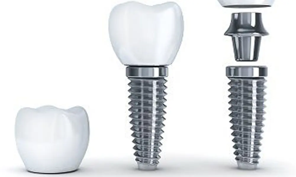 هزینه ایجاد اسکن ۳ بعدی برای ایمپلنت