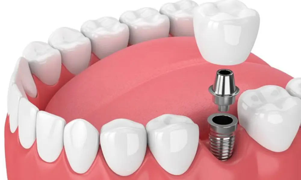 هزینه ایمپلنت‌گذاری چند واحدی در تهران چرا هزینه ایمپلنت‌گذاری چند واحدی در تهران متفاوت است؟ تهران شهری است با تنوع زیاد در نوع خدمات دندانپزشکی. همین تنوع باعث می‌شود قیمت‌ها از یک مرکز تا مرکز دیگر تفاوت داشته باشد. عوامل زیر بیشترین تأثیر را بر رقم نهایی دارند: ۱. برند ایمپلنت (مهم‌ترین عامل) ایمپلنت‌ها از نظر کیفیت ساخت، کشور سازنده، میزان ماندگاری و تکنولوژی‌های مورد استفاده با هم تفاوت دارند. کشورهای مطرح در تولید ایمپلنت عبارتند از: • سوئیس • آلمان • کره • آمریکا • ایتالیا • اسپانیا • چین (کیفیت پایین‌تر اما اقتصادی) هرچه برند معتبرتر باشد، قیمت قطعات و هزینه ایمپلنت‌گذاری نیز بالاتر خواهد بود. ایمپلنت‌های اروپایی و آمریکایی معمولاً بیشترین طول عمر و کمترین درصد شکست را دارند. ایمپلنت‌های کره‌ای کیفیت مناسب و قیمت منطقی‌تری دارند، به همین دلیل محبوب هستند. ۲. تعداد واحدهای مورد نیاز به‌طور طبیعی، هرچه تعداد دندان‌های ازدست‌رفته بیشتر باشد، هزینه درمان نیز افزایش پیدا می‌کند. اما نکته مهم این است که برای چند دندان کنار هم معمولاً نیاز به تعداد پایه کمتری دارید و این مسئله هزینه را منطقی‌تر می‌کند. ۳. جنس و نوع روکش روکش‌های دندانی انواع مختلفی دارند: • سرامیکی • زیرکونیا • سرامیک-فلز روکش‌های زیرکونیا از نظر زیبایی و مقاومت بهترین گزینه هستند اما قیمت بالاتری دارند. ۴. نیاز به جراحی‌های تکمیلی بعضی بیماران برای شروع ایمپلنت‌گذاری نیاز به اقدامات اضافه دارند، مثل: • پیوند استخوان • لیفت سینوس • کشیدن دندان‌های خراب • جراحی لثه • تقویت بافت نرم وجود یا عدم وجود این مراحل مستقیماً روی هزینه ایمپلنت‌گذاری تأثیر می‌گذارد. ۵. مهارت و تجربه دندانپزشک ایمپلنت‌گذاری چند واحدی یک فرایند دقیق، مهم و حساس است. هرچه متخصص تجربه بیشتری داشته باشد، احتمال موفقیت و عمر ایمپلنت‌ها بیشتر خواهد بود. طبیعی است که هزینه خدمات متخصصان باتجربه کمی بیشتر باشد، اما نتیجه درمان قابل‌اعتمادتر است. هزینه ایمپلنت‌گذاری چند واحدی در تهران چقدر است؟ در تهران، هزینه ایمپلنت‌گذاری چند واحدی حدودی و متغیر است. دلیل این تفاوت همان عواملی است که در بخش قبل توضیح داده شد. با این حال، برای آگاهی کلی، بازه‌های تقریبی هزینه‌ها به شکل زیر است: هزینه تقریبی پایه ایمپلنت (برای هر واحد): • برندهای اقتصادی: از ۱۵ میلیون تومان به بالا • برندهای کره‌ای باکیفیت: بین ۱۸ تا ۳۰ میلیون تومان • برندهای اروپایی: بین ۳۰ تا ۵۵ میلیون تومان • برندهای آمریکایی و سوئیسی: از ۵۵ میلیون تومان به بالا هزینه روکش دندان (برای هر واحد): • سرامیک: ۳ تا ۵ میلیون • زیرکونیا: ۵ تا ۸ میلیون • سرامیک-فلز: ۲ تا ۴ میلیون هزینه جراحی‌های تکمیلی (در صورت نیاز): • پیوند استخوان: ۵ تا ۱۵ میلیون • لیفت سینوس: ۱۰ تا ۳۰ میلیون این قیمت‌ها حدودی هستند و بسته به شرایط دهان، فک و روش انتخابی شما کاهش یا افزایش پیدا می‌کنند. مزایای ایمپلنت‌گذاری چند واحدی نسبت به روش‌های دیگر وقتی چند دندان از دست رفته باشد، روش‌های مختلفی برای جایگزینی وجود دارد، اما ایمپلنت‌گذاری مزایای بسیار مهمی دارد که باعث شده تبدیل به بهترین گزینه شود: ۱. جلوگیری از تحلیل استخوان وقتی دندان طبیعی از بین می‌رود، استخوان فک شروع به تحلیل می‌کند، اما ایمپلنت باعث تحریک استخوان می‌شود و جلوی این روند را می‌گیرد. ۲. عدم آسیب به دندان‌های کناری برخلاف بریج، برای ایمپلنت نیازی نیست دندان‌های سالم کناری تراش داده شوند. ۳. دوام و ماندگاری طولانی ایمپلنت‌های باکیفیت در صورت مراقبت درست، تا آخر عمر باقی می‌مانند. ۴. زیبایی لبخند و بازگشت اعتمادبه‌نفس روکش‌های امروزی ظاهر طبیعی و هماهنگ با سایر دندان‌ها دارند و لبخند را کاملاً زیبا می‌کنند. ۵. عملکرد طبیعی در غذا خوردن ایمپلنت مانند دندان واقعی عمل می‌کند و هیچ محدودیتی در جویدن ایجاد نمی‌کند. هزینه ایمپلنت‌گذاری چند واحدی چگونه کاهش می‌یابد؟ در بسیاری از موارد، می‌توان با انتخاب روش‌ها و برندهای مناسب، هزینه‌ها را مدیریت کرد بدون اینکه کیفیت درمان کاهش پیدا کند. ۱. انتخاب برند باکیفیت اما اقتصادی برندهای کره‌ای درجه یک بهترین تعادل میان کیفیت و هزینه را دارند. ۲. استفاده از روکش‌های استاندارد روکش‌های سرامیکی کیفیت خوبی دارند و نسبت به زیرکونیا ارزان‌ترند. ۳. درمان در زمان مناسب هرچه تحلیل استخوان کمتر باشد، نیاز به جراحی‌های تکمیلی کمتر خواهد شد. ۴. رعایت مراقبت‌های بعد از جراحی برای جلوگیری از مشکلات بعدی، رعایت بهداشت دهان بسیار مهم است.