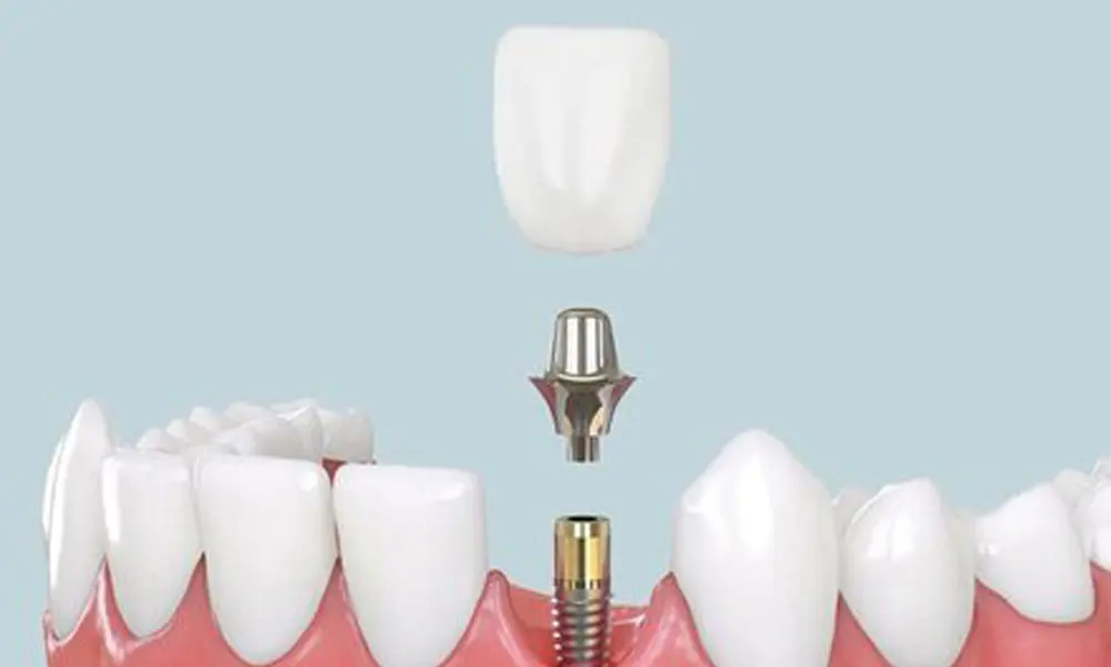 قیمت ایمپلنت ارزان در تهران — کدام کلینیک‌ها؟ ایمپلنت دندان به عنوان یکی از بهترین روش‌های جایگزینی دندان از دست رفته شناخته می‌شود. این روش علاوه بر بازگرداندن زیبایی لبخند، سلامت فک و دندان‌های مجاور را نیز تضمین می‌کند. اما یکی از دغدغه‌های اصلی افرادی که به دنبال کاشت دندان هستند، قیمت ایمپلنت ارزان در تهران است. در این مقاله قصد داریم به بررسی کامل هزینه‌های ایمپلنت، کلینیک‌های ارائه‌دهنده خدمات باکیفیت و اقتصادی، برندهای موجود و نکات مهم قبل و بعد از کاشت ایمپلنت بپردازیم تا تصمیم‌گیری شما آسان‌تر و هوشمندانه‌تر باشد. ایمپلنت دندان چیست؟ ایمپلنت دندان یک پایه تیتانیومی است که داخل استخوان فک قرار می‌گیرد و جایگزین ریشه دندان از دست رفته می‌شود. پس از جوش خوردن ایمپلنت با استخوان، روکش روی آن نصب می‌شود که عملکرد و ظاهر مشابه دندان طبیعی دارد. مزایای ایمپلنت شامل: • ماندگاری طولانی‌مدت، حتی تا مادام‌العمر • جلوگیری از آسیب به دندان‌های مجاور • حفظ ظاهر طبیعی لبخند • جلوگیری از تحلیل استخوان فک • بهترین روش دائمی جایگزینی دندان با وجود این مزایا، یکی از فاکتورهای تعیین‌کننده در انتخاب ایمپلنت، قیمت مناسب و دسترسی به خدمات باکیفیت است.