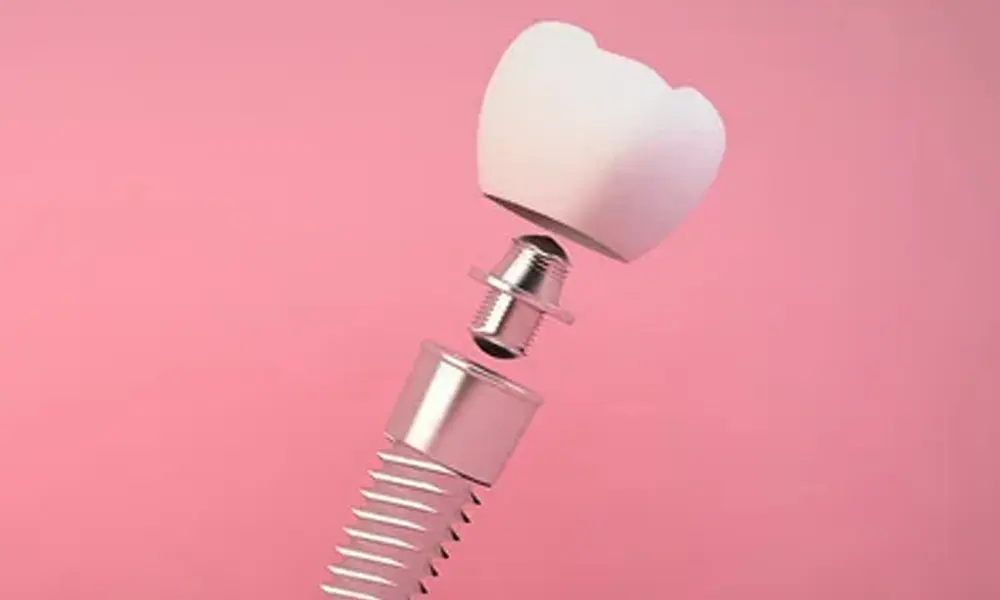 کیفیت خدمات پس از درمان ایمپلنت دندان تنها به جراحی محدود نمی‌شود؛ مراقبت‌های پس از درمان و پیگیری‌های منظم نیز بخش مهمی از فرآیند هستند. مراکز معتبر خدمات پس از درمان شامل بررسی سلامت ایمپلنت، تمیزکاری تخصصی و ارائه مشاوره برای مراقبت‌های روزانه هستند. ارائه این خدمات باعث می‌شود طول عمر ایمپلنت افزایش یابد و ریسک مشکلات کاهش یابد، اما هزینه‌های خدمات پس از درمان به قیمت نهایی اضافه می‌شوند. عوامل اقتصادی و منطقه‌ای قیمت ایمپلنت دندان تحت تاثیر عوامل اقتصادی مانند هزینه اجاره کلینیک، دستمزد پرسنل، مالیات و تعرفه‌های تجهیزات پزشکی قرار دارد. همچنین هزینه‌ها در شهرهای مختلف و بین کلینیک‌ها متفاوت است. مراکزی که در مناطق پرهزینه فعالیت می‌کنند، مجبور به اعمال قیمت بالاتر برای پوشش هزینه‌های خود هستند. این تفاوت‌ها می‌تواند درک بیماران از بالابودن قیمت ایمپلنت را توضیح دهد. دلایل کاهش قیمت ایمپلنت کاهش قیمت ایمپلنت می‌تواند دلایل متنوعی داشته باشد. اولین عامل، استفاده از مواد اولیه ارزان‌تر است که هزینه تولید را کاهش می‌دهد اما کیفیت و دوام ایمپلنت را تحت تاثیر قرار می‌دهد. دومین دلیل، انتخاب تکنولوژی‌های کمتر پیشرفته در روند جراحی و قالب‌گیری است. برخی مراکز با تبلیغات فصلی و تخفیف‌های موقت، هزینه‌ها را کاهش می‌دهند تا مشتری جذب کنند. همچنین رقابت بین مراکز خدمات‌دهنده باعث می‌شود برخی قیمت‌ها پایین‌تر بیایند، اما این کاهش قیمت همیشه به معنای صرفه‌جویی هوشمندانه نیست. ریسک‌های کاهش قیمت ایمپلنت کاهش قیمت ایمپلنت می‌تواند جذاب باشد، اما ریسک‌هایی جدی دارد که قبل از تصمیم‌گیری باید به آن‌ها توجه کنید. ۱. کیفیت پایین مواد ایمپلنت‌هایی که با مواد ارزان ساخته می‌شوند ممکن است دوام کوتاه‌تری داشته باشند و بافت استخوان اطراف دندان را تحریک کنند. در بلندمدت، احتمال شکست درمان افزایش می‌یابد و نیاز به تعویض یا اصلاح مجدد پیدا خواهید کرد. استفاده از مواد با کیفیت پایین، علاوه بر آسیب به سلامت دهان، می‌تواند هزینه‌های بعدی شما را افزایش دهد. . 2تجربه و مهارت ناکافی پزشک یکی دیگر از ریسک‌های مهم، تجربه ناکافی پزشک یا تیم درمانی است. مراکزی که برای کاهش قیمت از نیروهای تازه‌کار استفاده می‌کنند، احتمال اشتباهات جراحی، عفونت بعد از کاشت و نیاز به درمان‌های اضافی را بالا می‌برند. انتخاب درست پزشک و اطمینان از تجربه کافی او، یکی از مهم‌ترین نکات برای کاهش ریسک است. ۳. عدم پشتیبانی و گارانتی کافی بسیاری از مراکزی که قیمت را کاهش می‌دهند، خدمات پس از درمان را محدود می‌کنند. نبود گارانتی معتبر و پشتیبانی کافی می‌تواند در صورت بروز مشکل، شما را مجبور به پرداخت هزینه‌های اضافی کند. بنابراین قبل از انتخاب، حتماً درباره گارانتی و نوع پشتیبانی سوال کنید و مطمئن شوید که پوشش مناسبی دارید. مزایای کاهش قیمت ایمپلنت در شرایط مناسب اگر کاهش قیمت به دلیل رقابت سالم و انتخاب هوشمندانه باشد، می‌تواند فرصت خوبی باشد. افراد با بودجه محدود می‌توانند به درمان دسترسی پیدا کنند و تجربه خدمات بدون فشار مالی شدید داشته باشند. همچنین این رقابت می‌تواند کیفیت کلی خدمات را در سطح مراکز مختلف افزایش دهد، به شرطی که مراقبت‌ها و استانداردهای لازم رعایت شوند. جدول مقایسه ریسک‌ها و مزایا ریسک کاهش قیمت ایمپلنت توضیح احتمال وقوع تأثیر کیفیت پایین مواد دوام کمتر و مشکلات استخوانی زیاد بالا تجربه ناکافی پزشک اشتباهات جراحی و عفونت متوسط بالا پشتیبانی ناکافی نداشتن گارانتی و هزینه‌های اضافی زیاد متوسط کاهش هزینه دسترسی بیشتر و رقابت سالم کم متوسط نکات کلیدی برای کاهش ریسک انتخاب مرکز معتبر تحقیق کامل قبل از انتخاب مرکز، بررسی نمونه کارهای قبلی و پرسش درباره خدمات پس از درمان، مهم‌ترین مراحل قبل از تصمیم‌گیری هستند. اطمینان از اعتبار مرکز و بررسی نظرات بیماران قبلی می‌تواند کمک کند تا از کاهش قیمت به شکل هوشمندانه بهره‌مند شوید. آگاه بودن از مواد و تکنولوژی اطمینان از کیفیت مواد ایمپلنت، بررسی نوع و برند آن و اطلاع از تکنولوژی‌های به‌روز، تاثیر زیادی بر موفقیت درمان دارد. مراکزی که از تکنولوژی‌های استاندارد و مواد با کیفیت استفاده می‌کنند، حتی با قیمت کمتر هم می‌توانند نتیجه‌ای مطمئن ارائه دهند. مراقبت‌های بعد از ایمپلنت رعایت نکات بهداشتی، مراجعه منظم برای چکاپ و اطلاع‌رسانی سریع در صورت بروز هرگونه مشکل، می‌تواند ریسک شکست درمان را به حداقل برساند و دوام ایمپلنت را افزایش دهد.