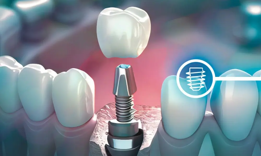 قیمت ایمپلنت ارزان در تهران — کدام کلینیک‌ها؟