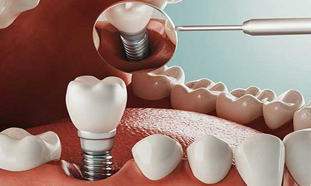 هزینه ایمپلنت در تهران برای بیماران خاص (مثلاً دیابتی‌ها)