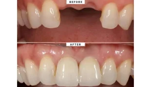 هزینه ایمپلنت در تهران برای بیماران خاص (مثلاً دیابتی‌ها)