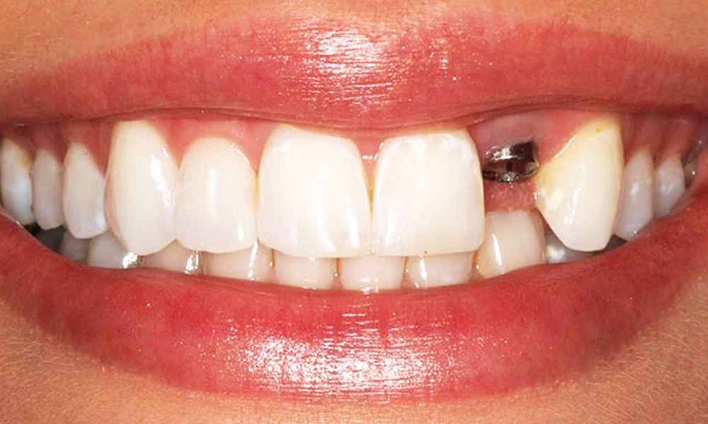 مقایسه قیمت ایمپلنت برند ناشناخته با برندهای بزرگ