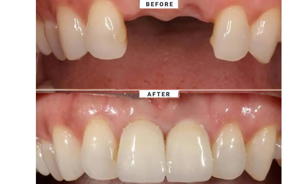 هزینه ایمپلنت در تهران برای بیماران خاص (مثلاً دیابتیها)