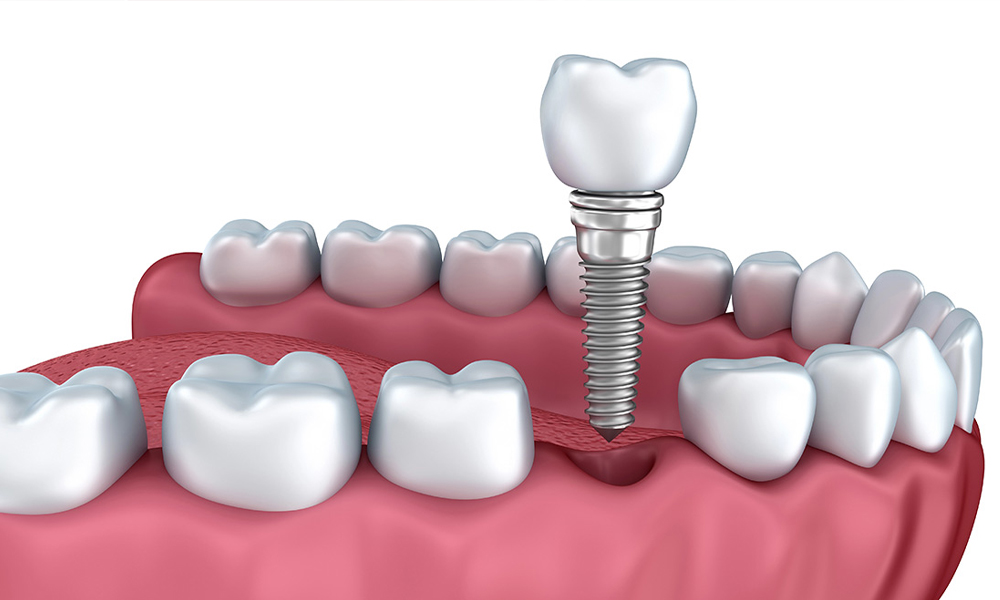 هزینه ایمپلنت در تهران برای بیماران خاص (مثلاً دیابتی‌ها)