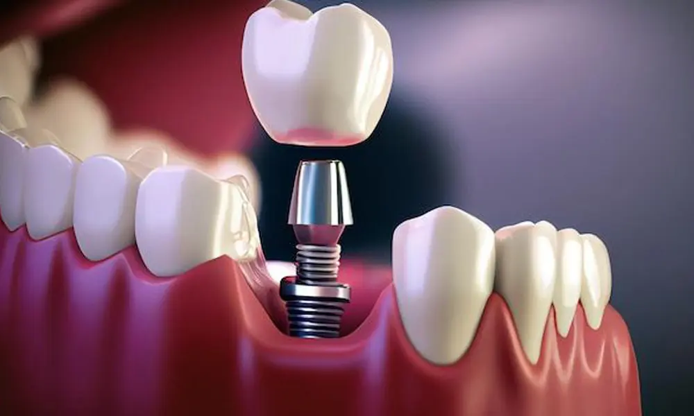 قیمت ایمپلنت برای بازسازی فک در تهران