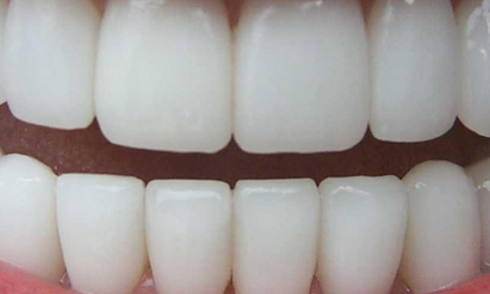 امکان کاشت ایمپلنت بدون جراحی در تهران؛ روش فلپ‌لس و مزایا