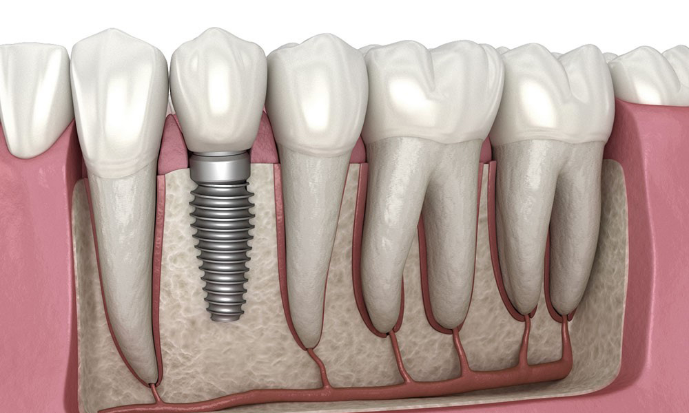 مقایسه ایمپلنت دندان در تهران با دیگر شهرها