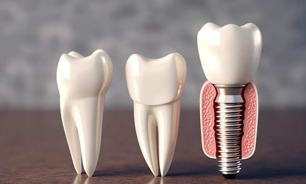 مقایسه ایمپلنت دندان در تهران با دیگر شهرها