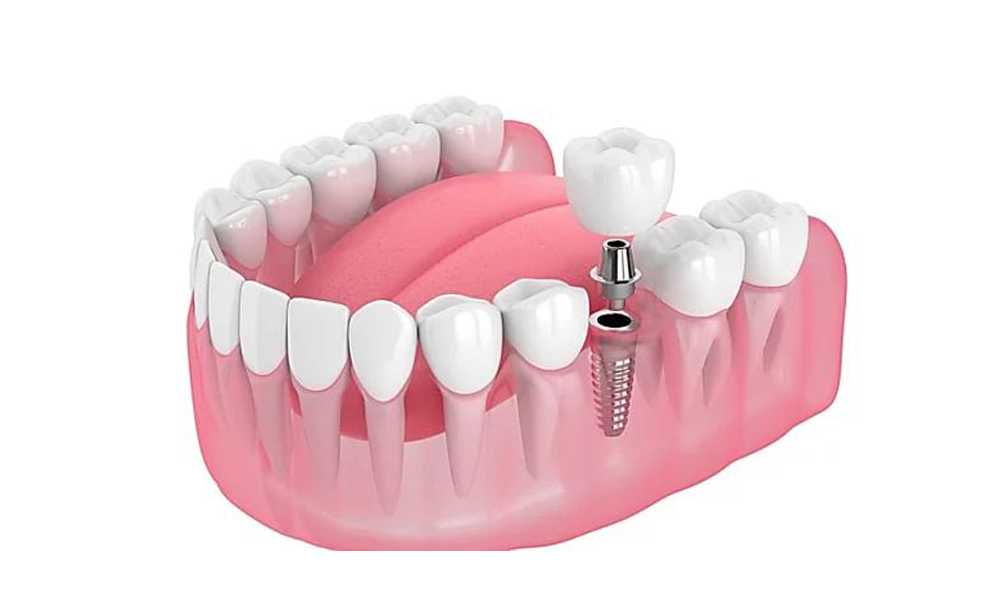 قیمت ایمپلنت دندان در تهران ۱۴۰۴،راهنمای کامل