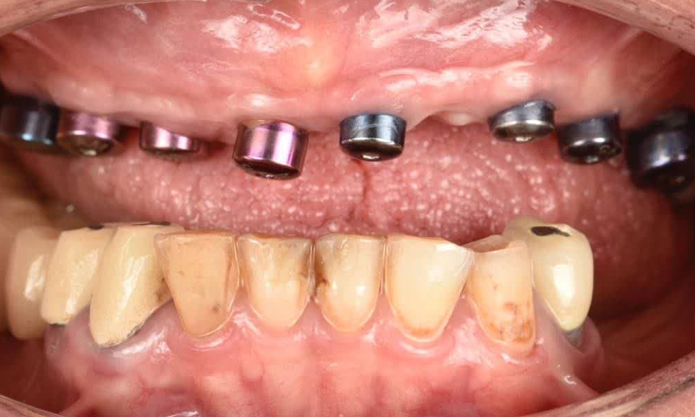 ایمپلنت دیجیتال: واقعیت یا فقط تبلیغات پر زرق‌وبرق کلینیک‌ها؟