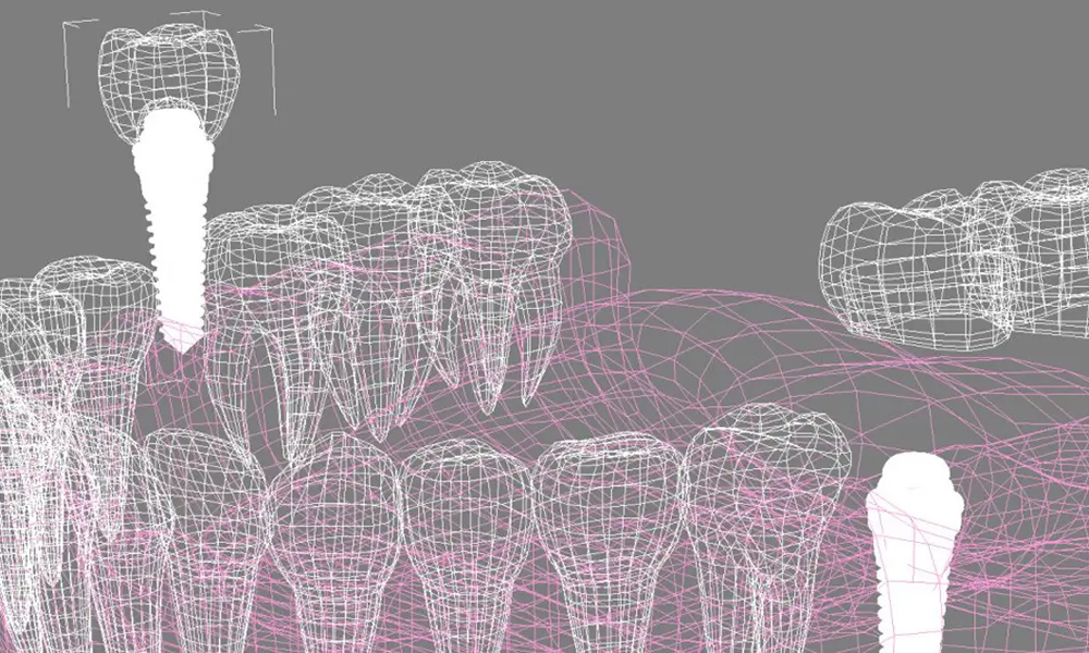 ایمپلنت دیجیتال: واقعیت یا فقط تبلیغات پر زرق‌وبرق کلینیک‌ها؟