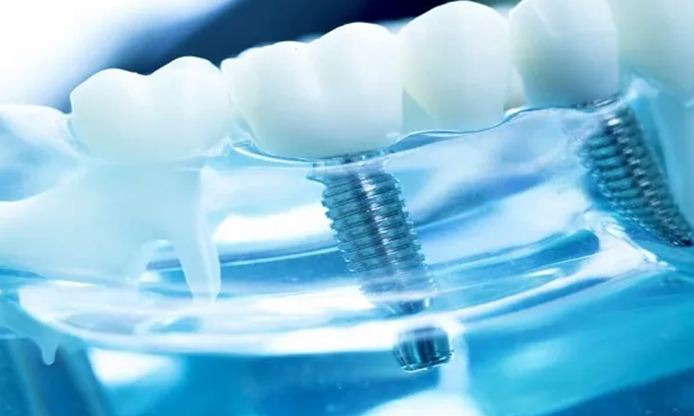 ایمپلنت دیجیتال: واقعیت یا فقط تبلیغات پر زرق‌وبرق کلینیک‌ها؟