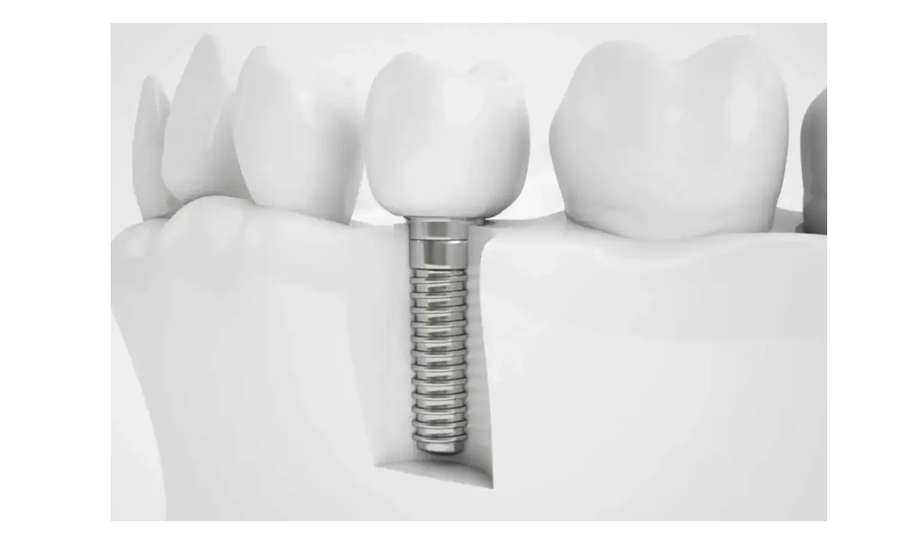 مراحل کاشت ایمپلنت دندان در تهران؛ از معاینه تا پروتز نهایی