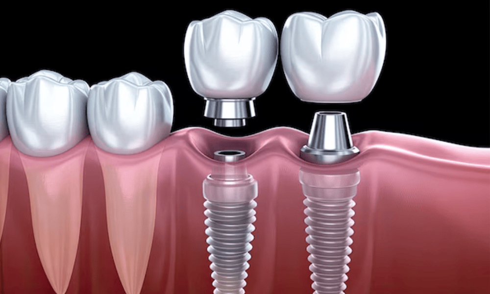 مراحل کاشت ایمپلنت دندان در تهران؛ از معاینه تا پروتز نهایی