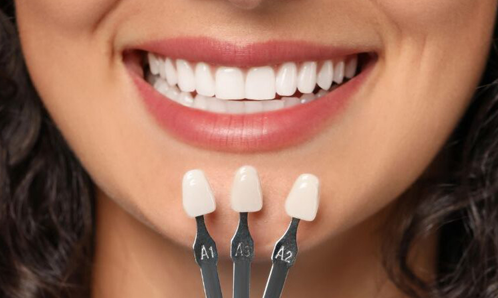 مراحل کاشت ایمپلنت دندان در تهران؛ از معاینه تا پروتز نهایی