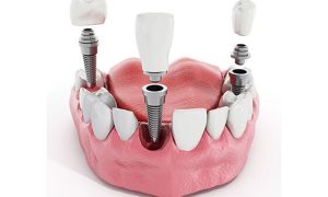 برندهای معتبر ایمپلنت موجود در تهران؛ بررسی مزایا و محدوده قیمت