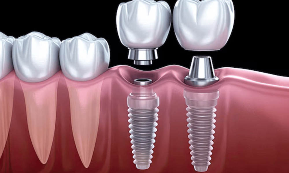 برندهای معتبر ایمپلنت موجود در تهران؛ بررسی مزایا و محدوده قیمت