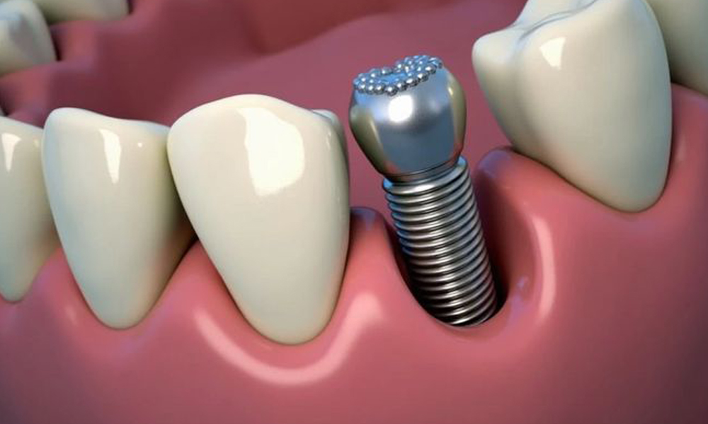 بهترین کلینیک‌های ایمپلنت دندان در تهران از نظر بیماران
