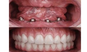 لیست قیمت ایمپلنت در تهران بر اساس انواع فک، تک دندان و درمان کامل