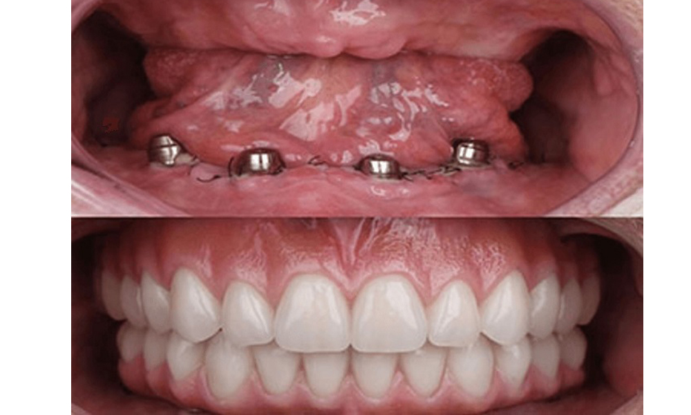 لیست قیمت ایمپلنت در تهران بر اساس انواع فک، تک دندان و درمان کامل