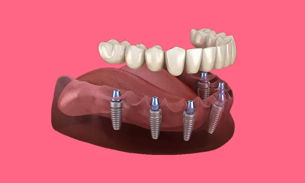لیست قیمت ایمپلنت در تهران بر اساس انواع فک، تک دندان و درمان کامل