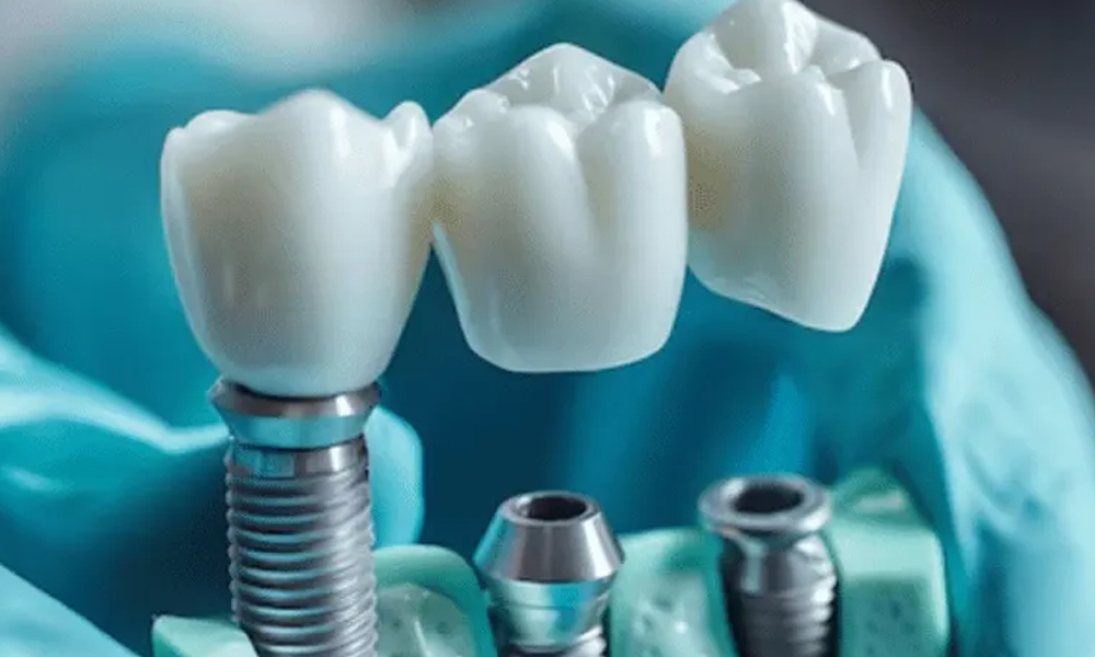 لیست قیمت ایمپلنت در تهران بر اساس انواع فک، تک دندان و درمان کامل