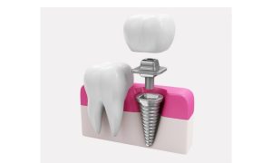 ایمپلنت دندان برای سالمندان در تهران؛ شرایط، محدودیت‌ها و بهترین روش‌ها