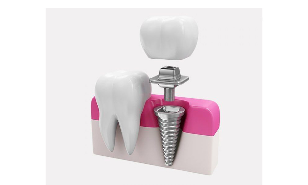 ایمپلنت دندان برای سالمندان در تهران؛ شرایط، محدودیت‌ها و بهترین روش‌ها