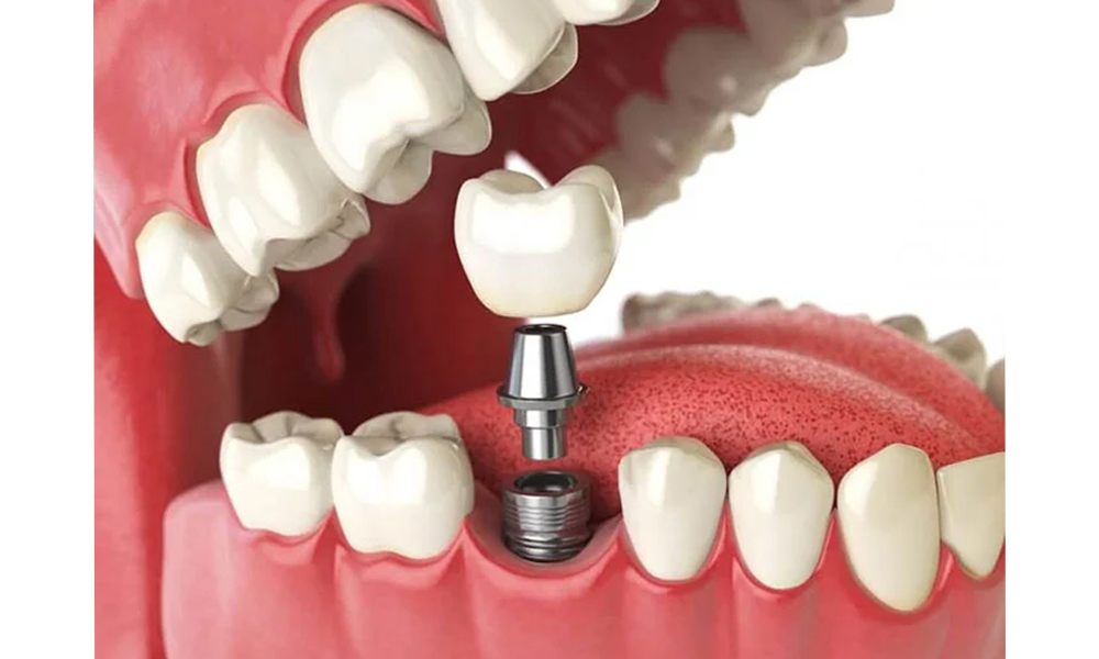 ایمپلنت دندان برای سالمندان در تهران؛ شرایط، محدودیت‌ها و بهترین روش‌ها