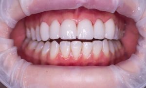 امکان کاشت ایمپلنت بدون جراحی در تهران؛ روش فلپ‌لس و مزایا