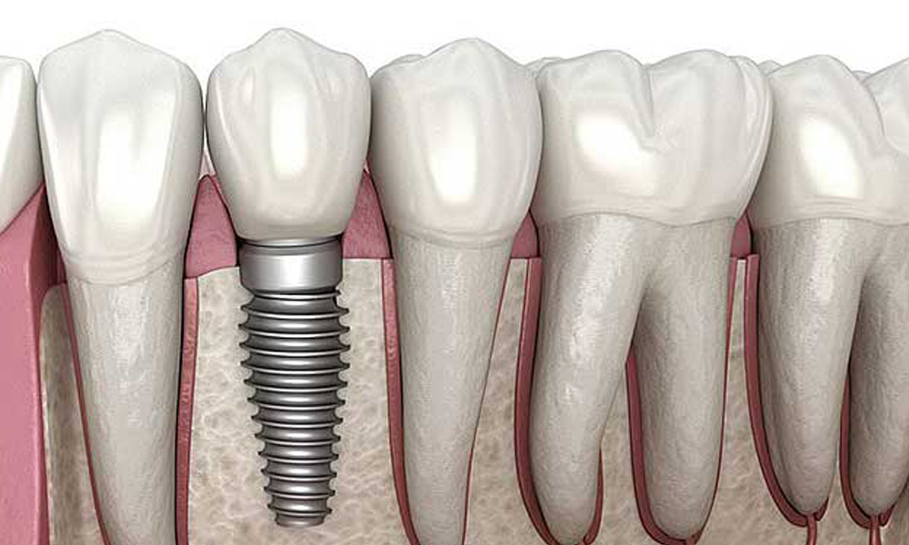 امکان کاشت ایمپلنت بدون جراحی در تهران؛ روش فلپ‌لس و مزایا