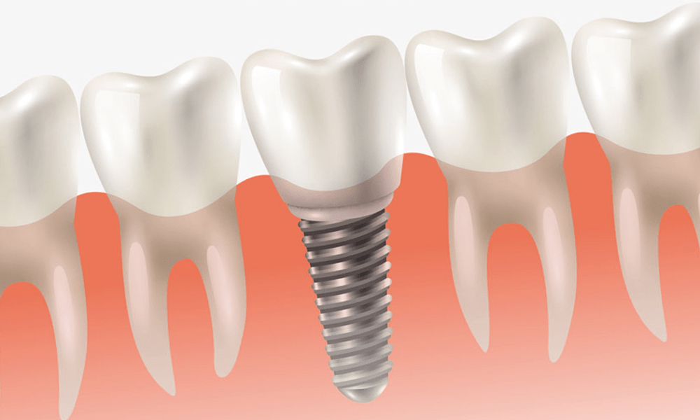 مقایسه ایمپلنت دندان در تهران با دیگر شهرها