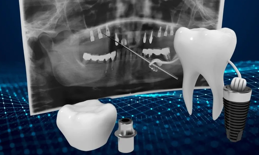 ایمپلنت اقساطی در تهران؛ شرایط پرداخت، مزایا و محدودیت‌ها