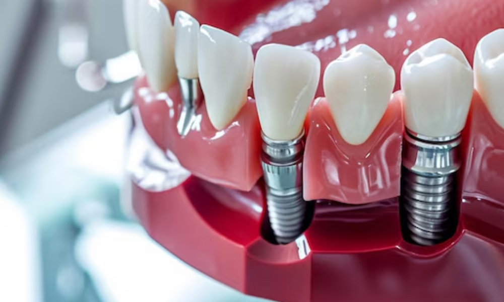 ایمپلنت اقساطی در تهران؛ شرایط پرداخت، مزایا و محدودیت‌ها