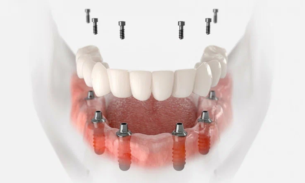 ایمپلنت اقساطی در تهران؛ شرایط پرداخت، مزایا و محدودیت‌ها