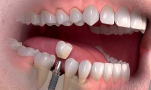 ایمپلنت فوری در تهران؛ مزایا، معایب و مناسب‌ترین افراد