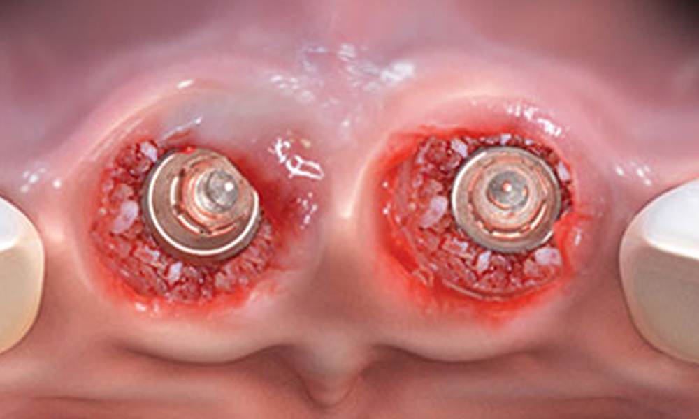 ایمپلنت فوری در تهران؛ مزایا، معایب و مناسب‌ترین افراد