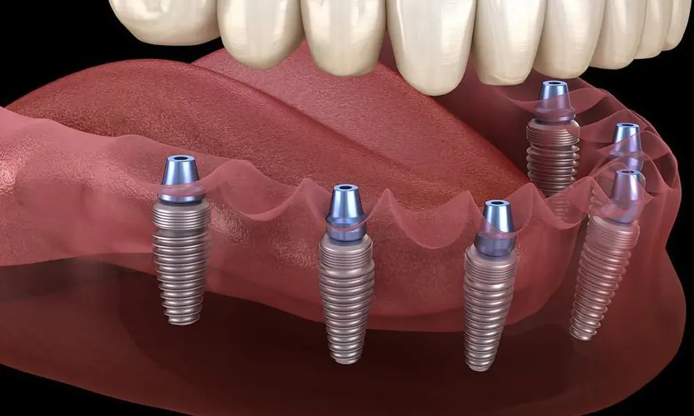 بهترین متخصص ایمپلنت در تهران چه ویژگی‌هایی دارد؟ راهنمای انتخاب پزشک