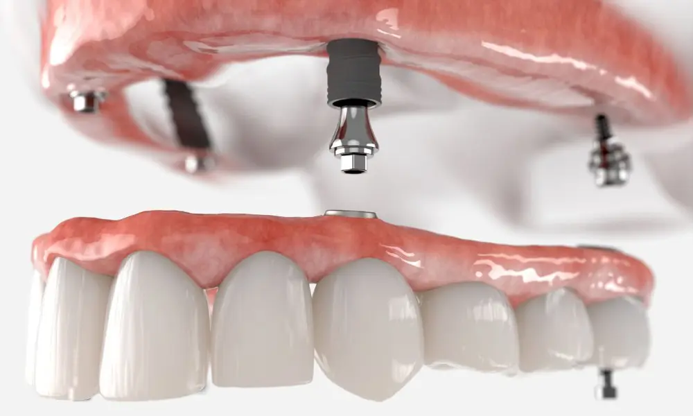 بهترین متخصص ایمپلنت در تهران چه ویژگی‌هایی دارد؟ راهنمای انتخاب پزشک