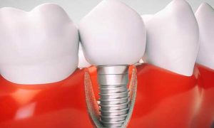 مشاوره ایمپلنت رایگان در تهران