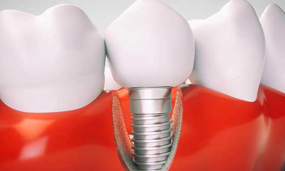 مشاوره ایمپلنت رایگان در تهران