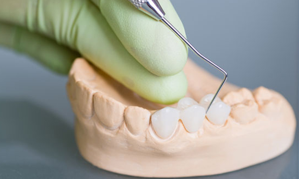 مشاوره ایمپلنت رایگان در تهران
