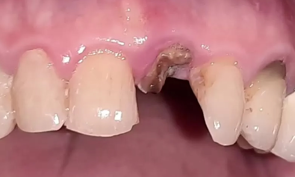 مشاوره ایمپلنت رایگان در تهران