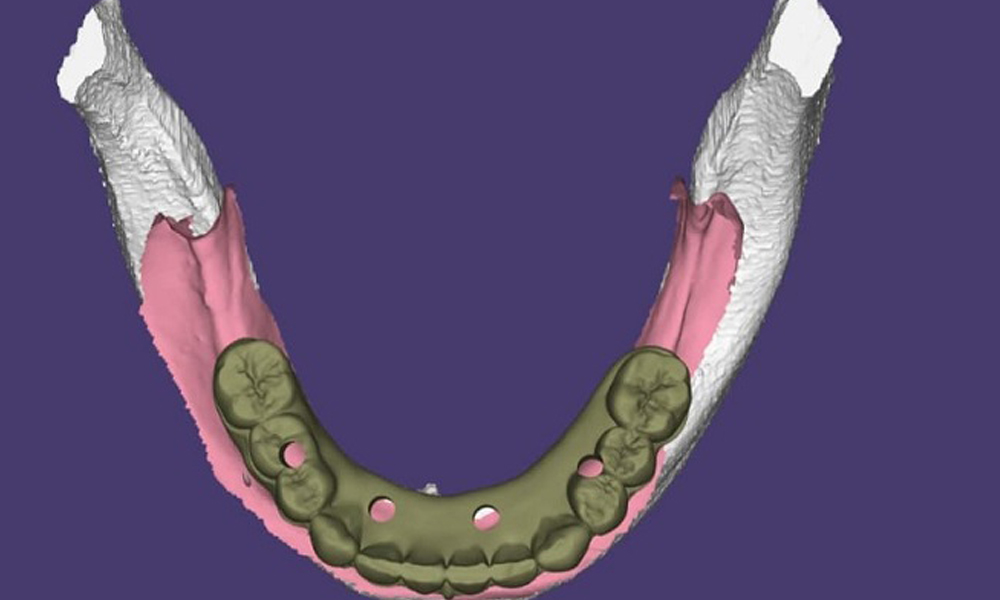 مشاوره ایمپلنت رایگان در تهران